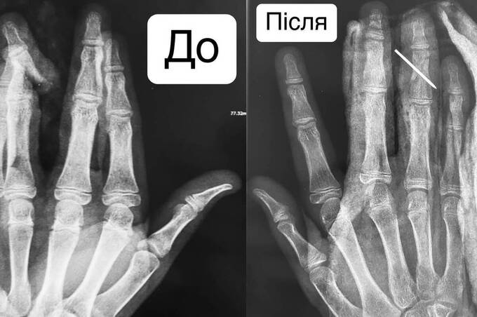 Вінницькі лікарі врятували від ампутації палець хлопчика після падіння з самоката