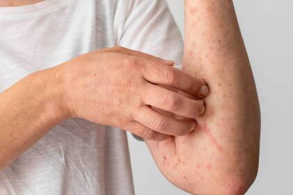 На Вінниччині різко зросла захворюваність на кір: що відомо