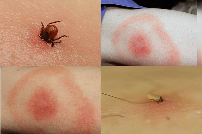 У листопаді 2025 року на Вінниччині зафіксували 23 випадки хвороби Лайма