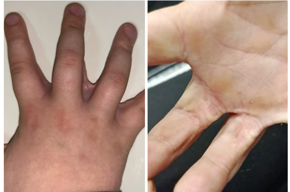 Вінницькі хірурги відновили рухливість пальців у 9-річного хлопчика після опіку